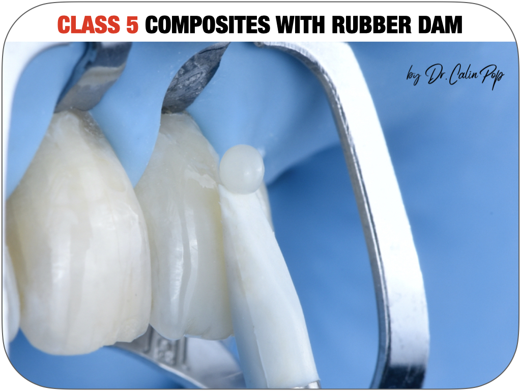 6. CLASS 5 COMPOSITES WITH RUBBER DAM 1